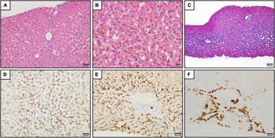 Case Report: A Rare Case of Benign Recurrent Intrahepatic Cholestasis-Type 1 With a Novel Heterozygous Pathogenic Variant of ATP8B1